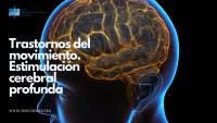 Trastornos del movimiento. Estimulación cerebral profunda